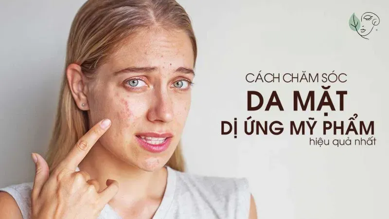 Hướng dẫn cách chăm sóc da khi bị dị ứng mỹ phẩm