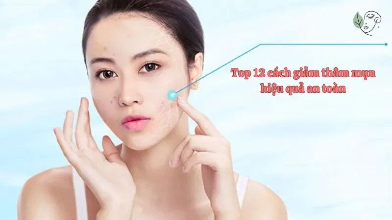 Top 12 cách giảm thâm mụn hiệu quả an toàn