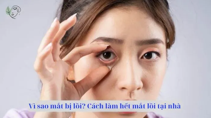 Vì sao mắt bị lồi? Cách làm hết mắt lồi đơn giản