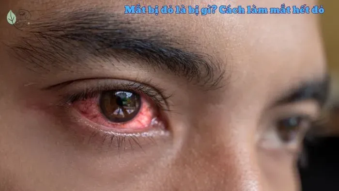 Mắt bị đỏ là bị gì? Cách làm mắt hết đỏ