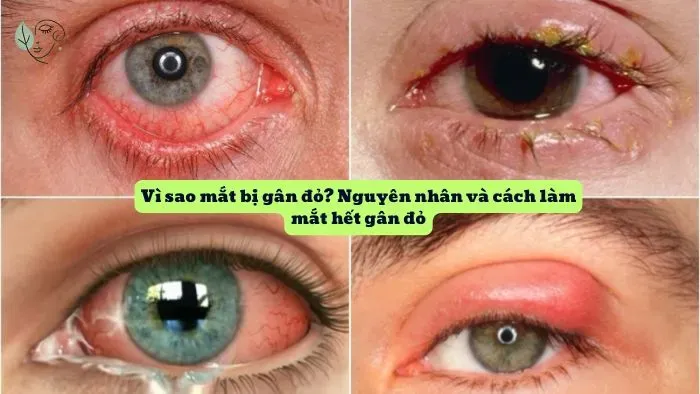 Vì sao mắt bị gân đỏ? Nguyên nhân và cách làm mắt hết gân đỏ