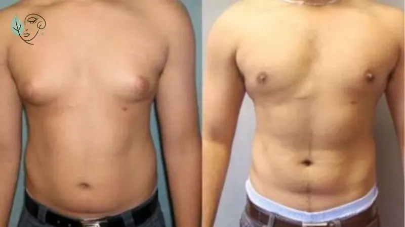 Hướng dẫn cách làm ngực nhỏ lại cho tomboy