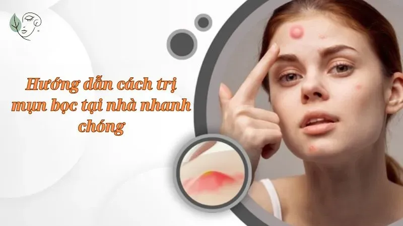 Hướng dẫn cách trị mụn bọc tại nhà nhanh chóng
