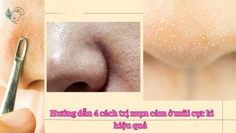 Hướng dẫn 4 cách trị mụn cám ở mũi cực kì hiệu quả