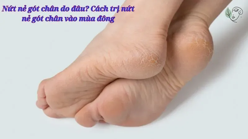 Nứt nẻ gót chân do đâu? Cách trị nứt nẻ gót chân vào mùa đông