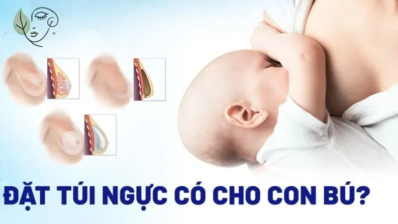 Làm ngực có cho con bú được không?