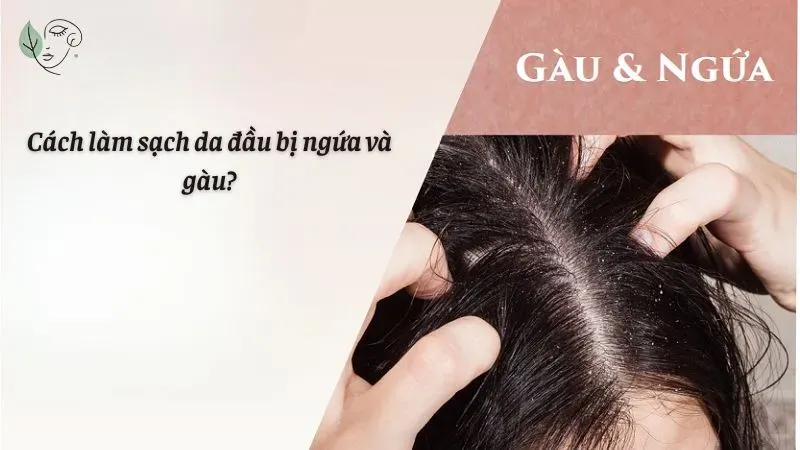 Cách làm sạch da đầu bị ngứa và gàu?