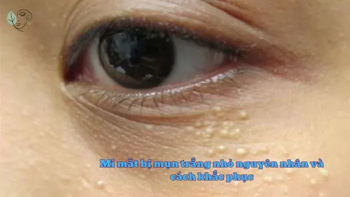 Mí mắt bị mụn trắng nhỏ nguyên nhân và cách khắc phục