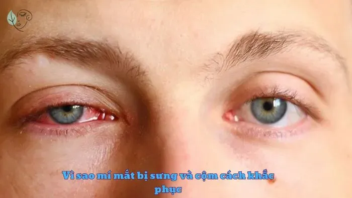 Vì sao mí mắt bị sưng và cộm cách khắc phục