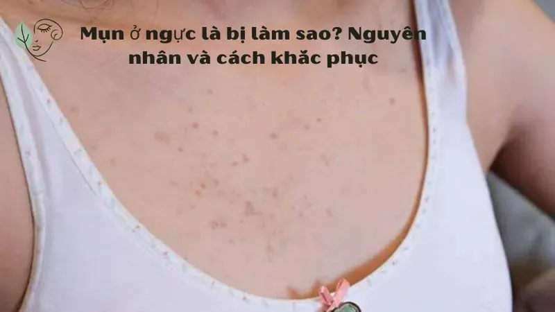 Mụn ở ngực là bị làm sao? Nguyên nhân và cách khắc phục