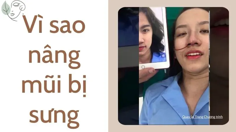 7 Cách giảm sưng sau nâng mũi hiệu quả