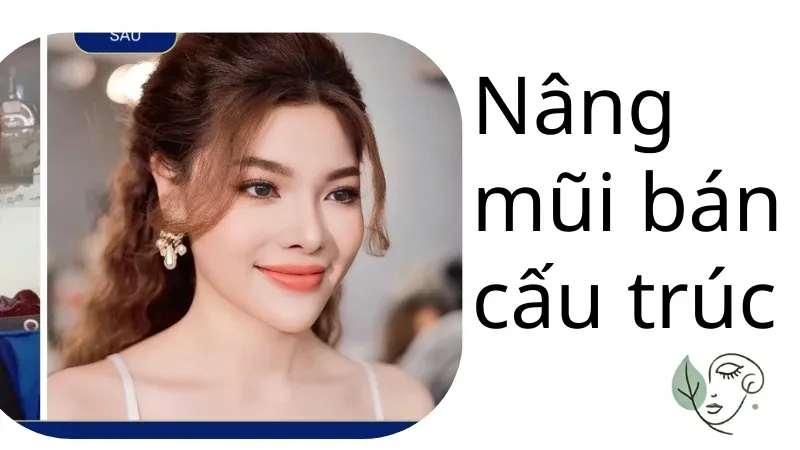 Lợi ích của nâng mũi bán cấu trúc - Cần làm gì sau nâng mũi?
