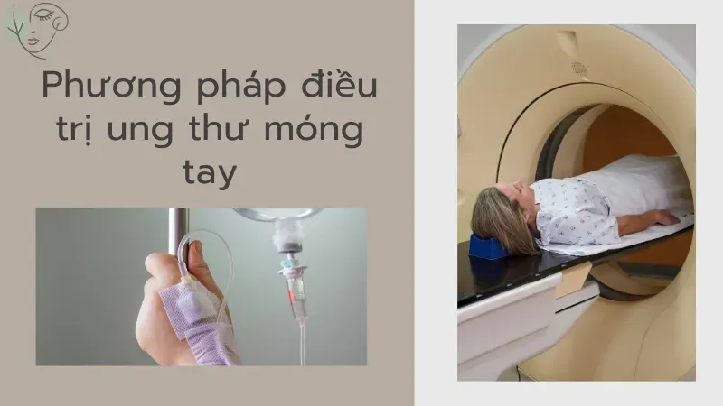 5 dấu hiệu móng tay bị ung thư bạn không nên bỏ qua