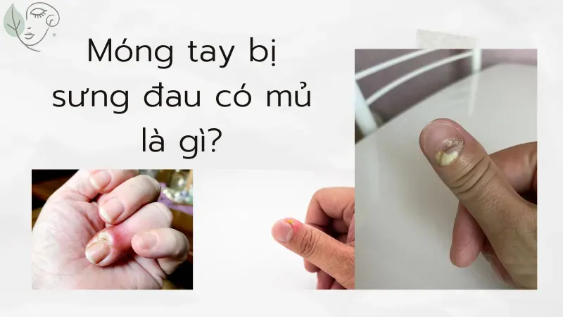 Cách điều trị khóe móng tay bị sưng đau có mủ dứt điểm