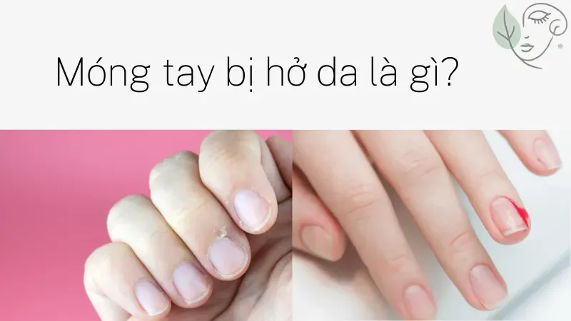 Nguyên nhân móng tay bị hở da và phương pháp khắc phục