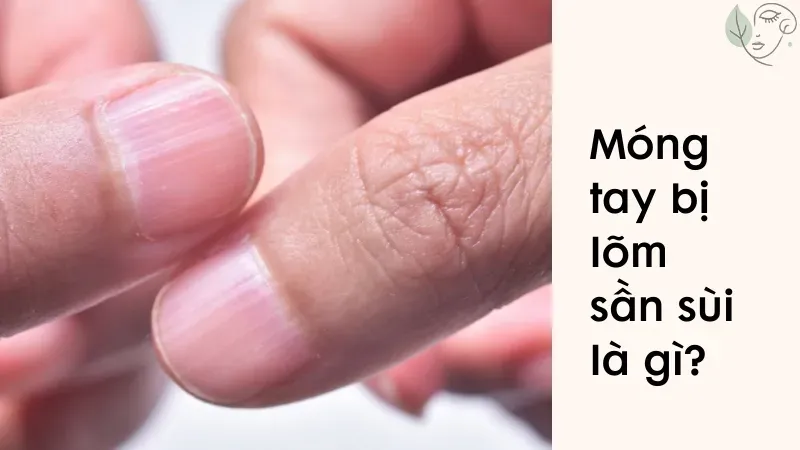 Móng tay lõm sần sùi bị bệnh gì? Giải pháp khắc phục hiệu quả
