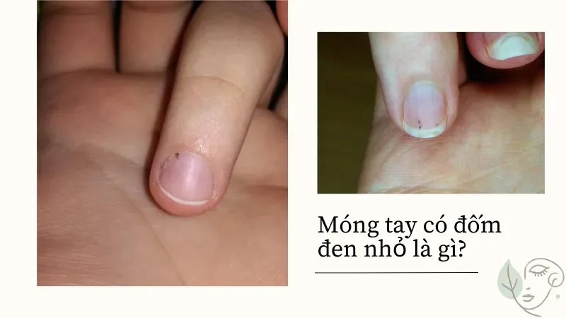 Móng tay có đốm đen nhỏ là dấu hiệu của bệnh lý nguy hiểm gì?