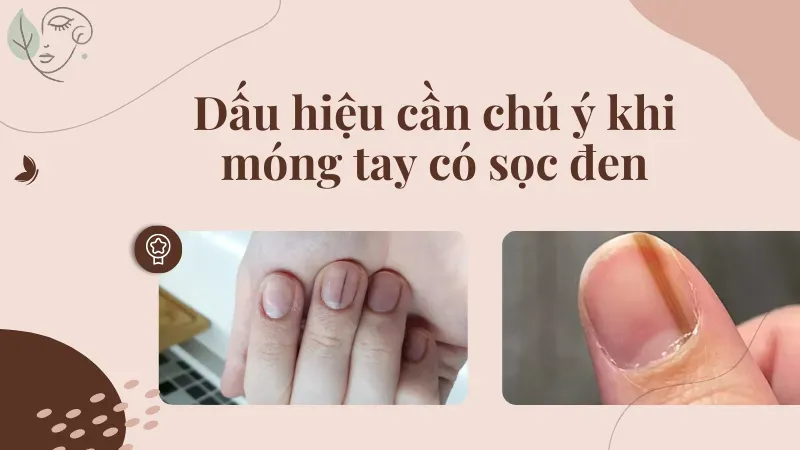 Móng tay có sọc đen phải chăng dấu hiệu của ung thư?