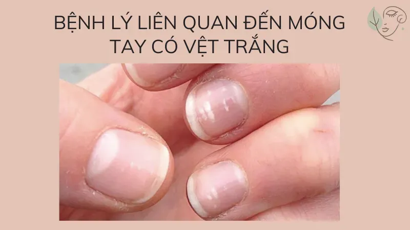 Móng tay có vệt trắng cảnh báo về sức khỏe cho bạn thế nào?