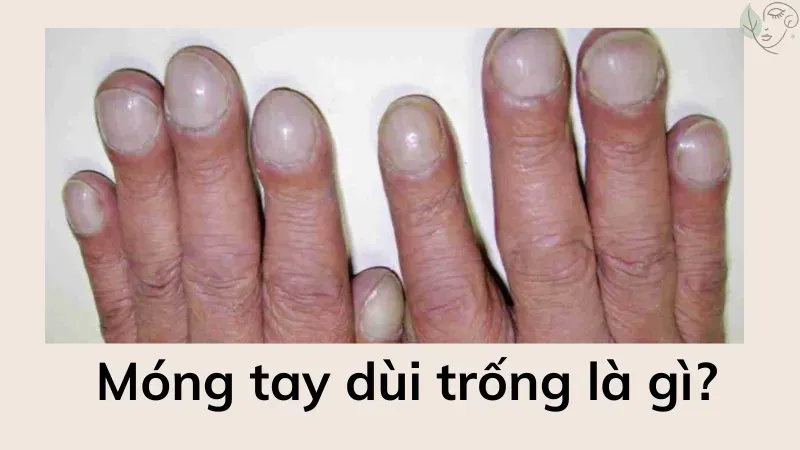 Móng tay dùi trống cảnh báo dấu hiệu sức khỏe nghiêm trọng