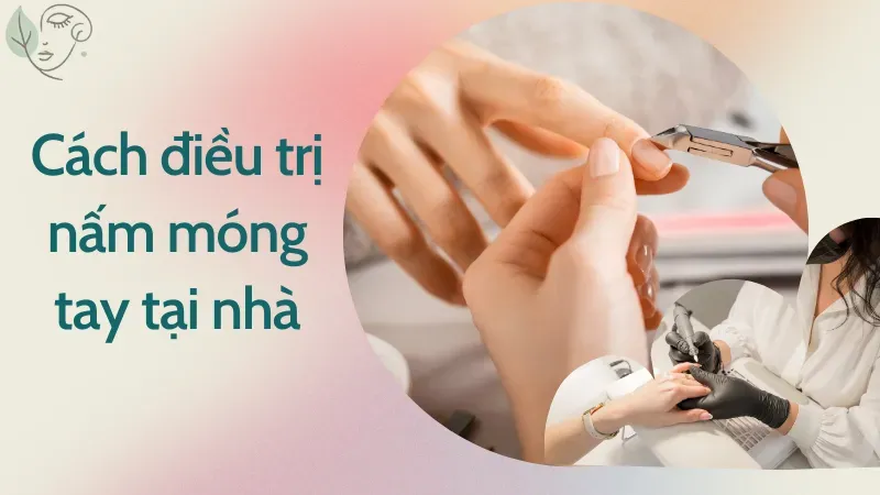 Dấu hiệu của nấm móng tay và cách điều trị chi tiết tại nhà