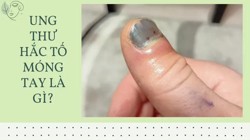 Cách phát hiện ung thư hắc tố móng tay và phương pháp điều trị