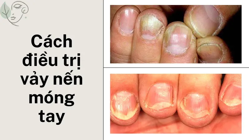 Phương pháp điều trị vảy nến móng tay hiệu quả nhất