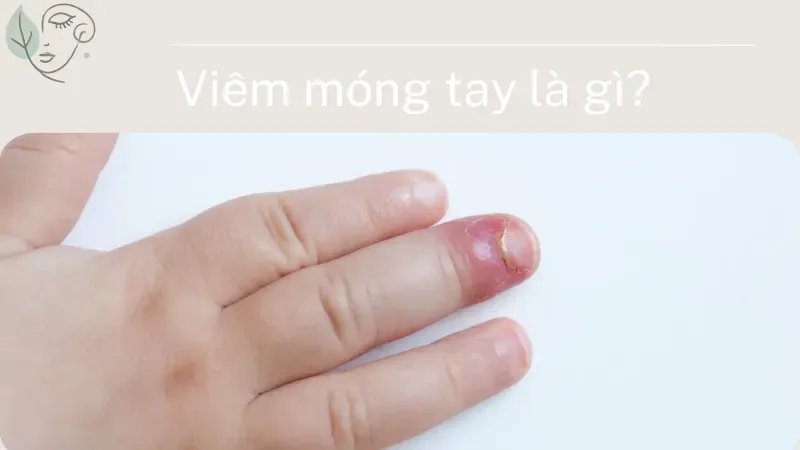 Viêm móng tay là gì? Nguyên nhân và cách điều trị dứt điểm