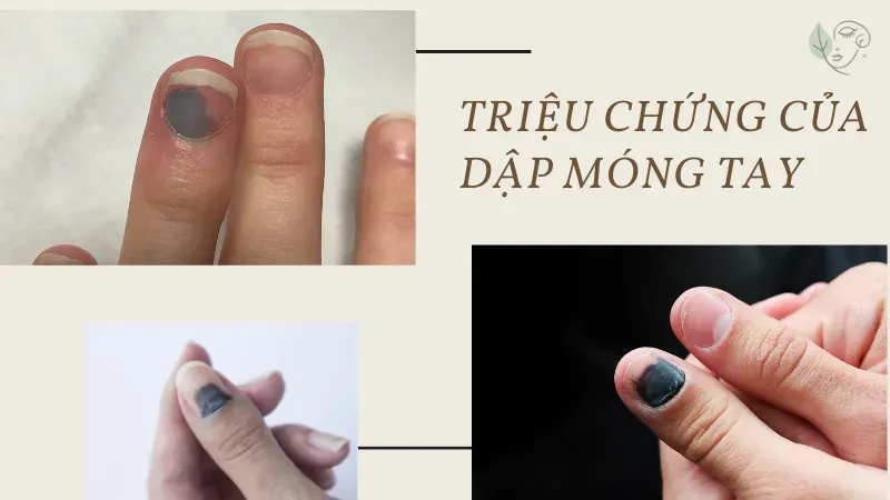 Móng tay bị dập bao lâu thì khỏi? Cách điều trị hiệu quả