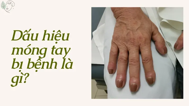 Dấu hiệu móng tay bị bệnh có thể bạn đang bỏ qua