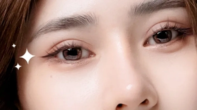 Phẫu thuật thẩm mỹ tạo mắt cười – Có nên không?