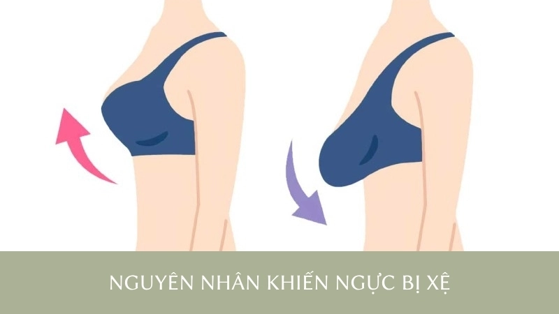 Nguyên nhân khiến ngực bị xệ