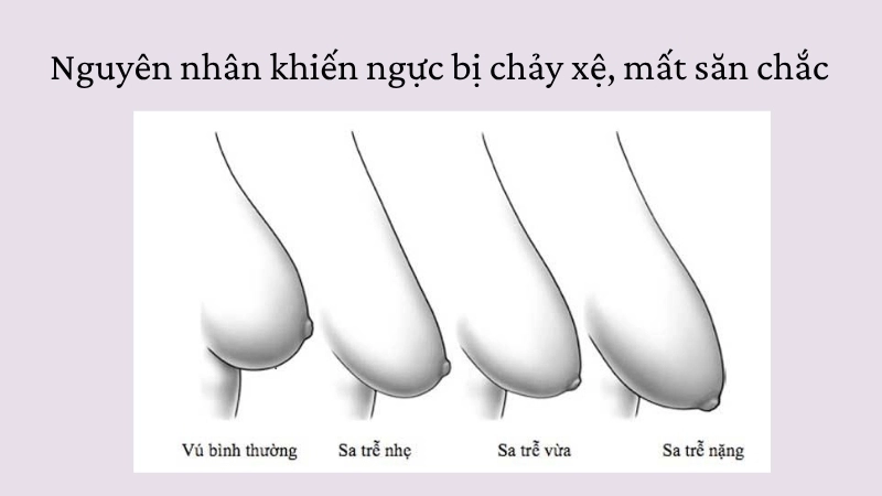 Nguyên nhân khiến ngực bị chảy xệ, mất săn chắc