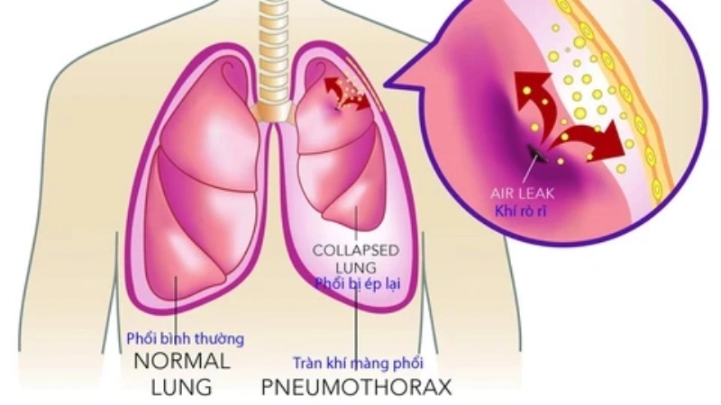 Tràn khí màng phổi