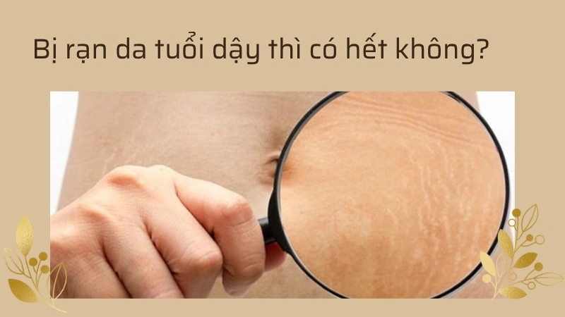 Bị rạn da tuổi dậy thì có hết không?