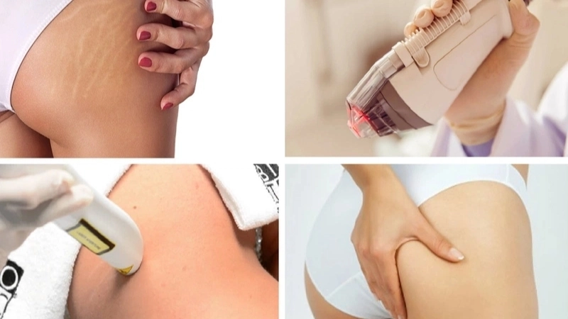 Phương pháp điều trị rạn da chuyên sâu