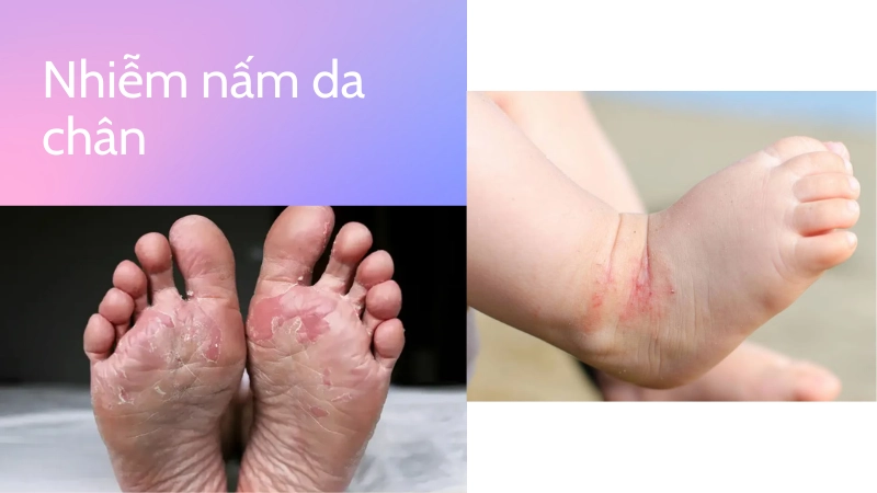 Nguyên nhân gây nhiễm nấm phổ biến nhất