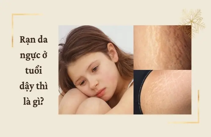 Làm thế nào để hạn chế rạn da ngực ở tuổi dậy thì?