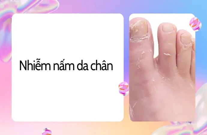 Cách chữa nhiễm nấm da chân hiệu quả, dứt điểm ngay tại nhà