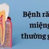Bệnh răng miệng thường gặp do thói quen thuộc hằng ngày
