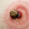 Bệnh Lyme là gì? Nguyên nhân, triệu chứng và cách phòng ngừa chi tiết