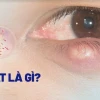 Bị nổi lẹo mắt: Nguyên nhân, dấu hiệu và cách xử lý hiệu quả