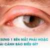Bọng mắt bị sưng một bên: Nguyên nhân, dấu hiệu và cách khắc phục hiệu quả