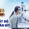 Đau mắt đỏ kiêng ăn gì và những thực phẩm cần tránh để mau khỏi bệnh