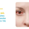 Đau mắt đỏ: Triệu chứng, nguyên nhân và cách phòng ngừa hiệu quả