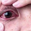 Đau mắt hàn uống thuốc gì để mau khỏi và những lưu ý cần biết