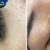 Hình ảnh sau khi xóa xăm mí mắt: Kỳ vọng và thực tế