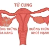 Hội chứng buồng trứng đa nang là gì? Nguyên nhân, dấu hiệu và cách điều trị