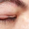 Mắt Tự Nhiên Bị Đỏ Không Đau: Nguyên Nhân và Cách Xử Lý