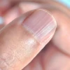 Móng tay có sọc dọc là bệnh gì và dấu hiệu cảnh báo sức khỏe